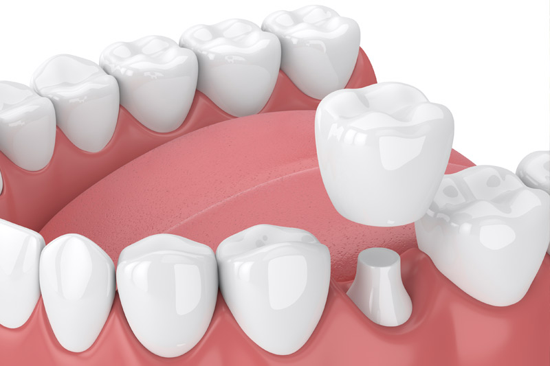 Dental Crowns in Fountain Valley