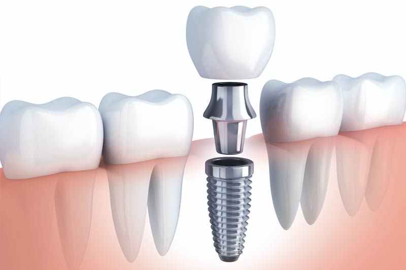 Implants Dentist in Fountain Valley